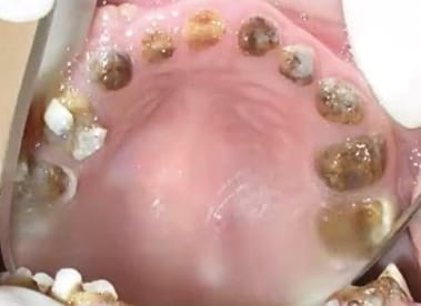 Imagen clínica intraoral