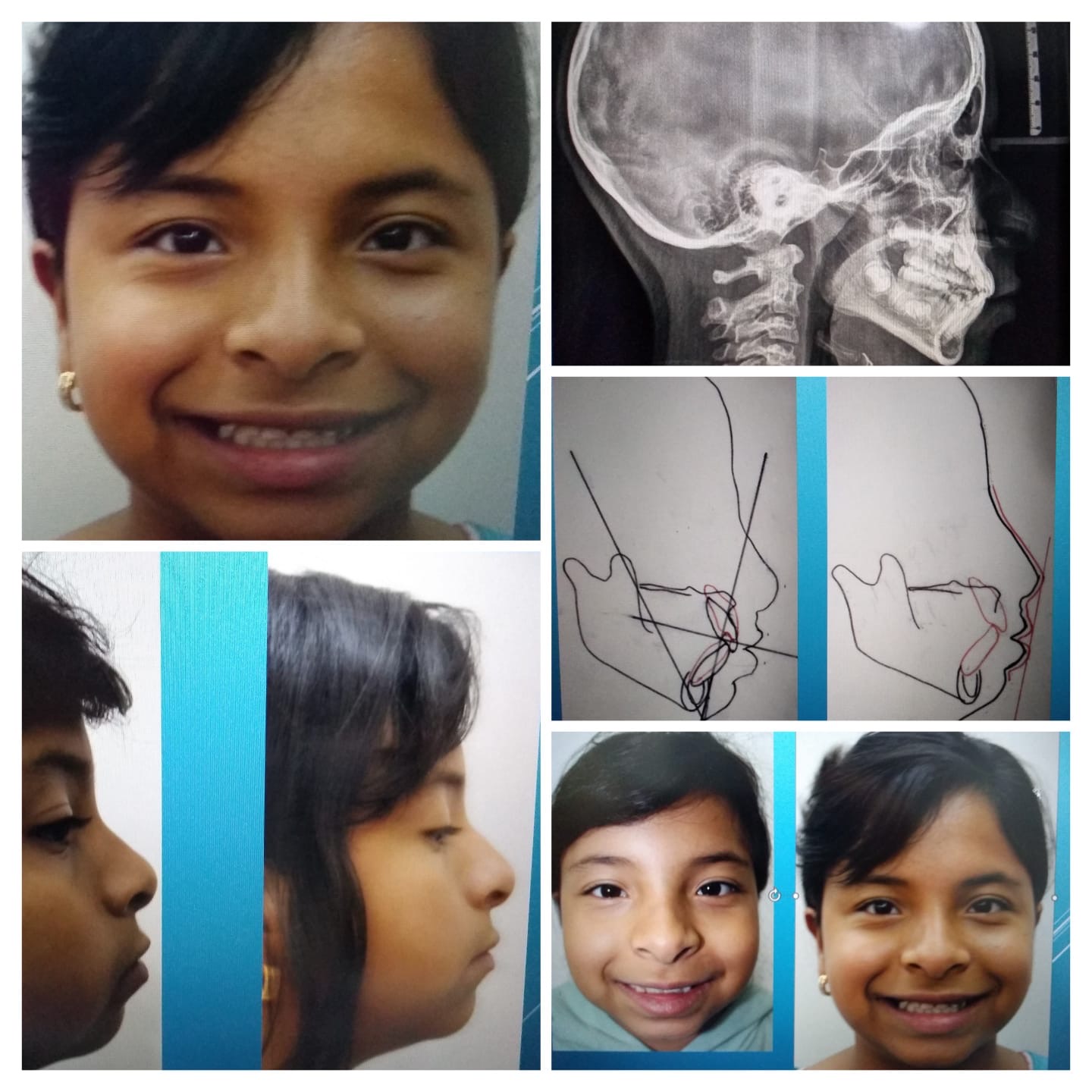 Registro visual de caso de ortopedia maxilar