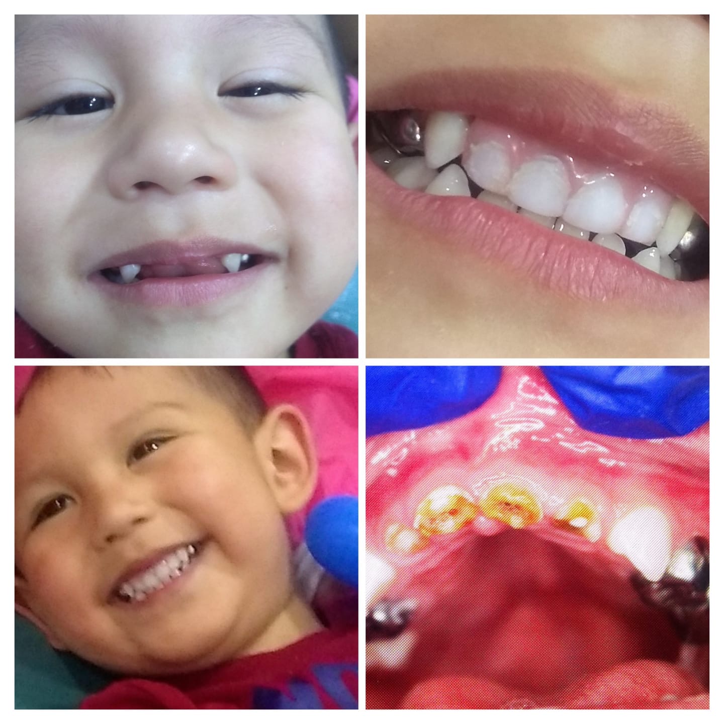 Paciente infantil mostrando su sonrisa